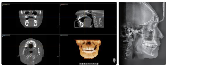 CT 9 sec, Scan Cephalo 1.9 sec