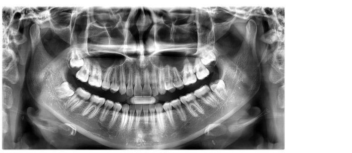 panorama 엑스레이 사진