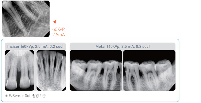 60KvP, 2.5mA 엑스레이사진과 EzSensor Soft 촬영사진